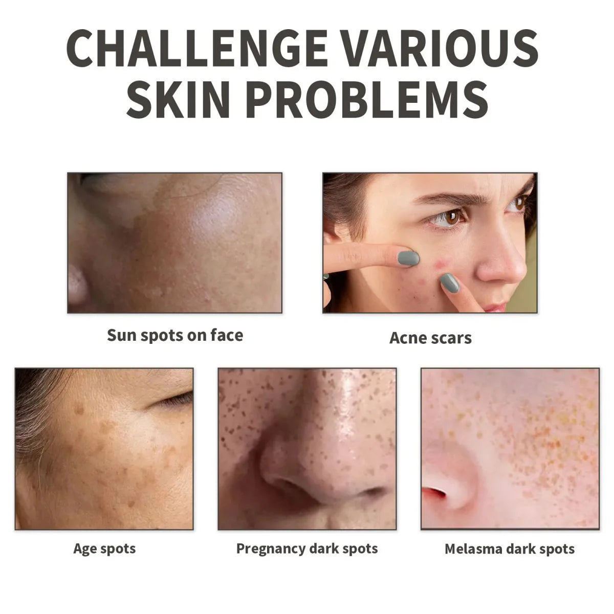 Collage showcasing various skin issues: sun spots, acne scars, age spots, pregnancy dark spots, and melasma.